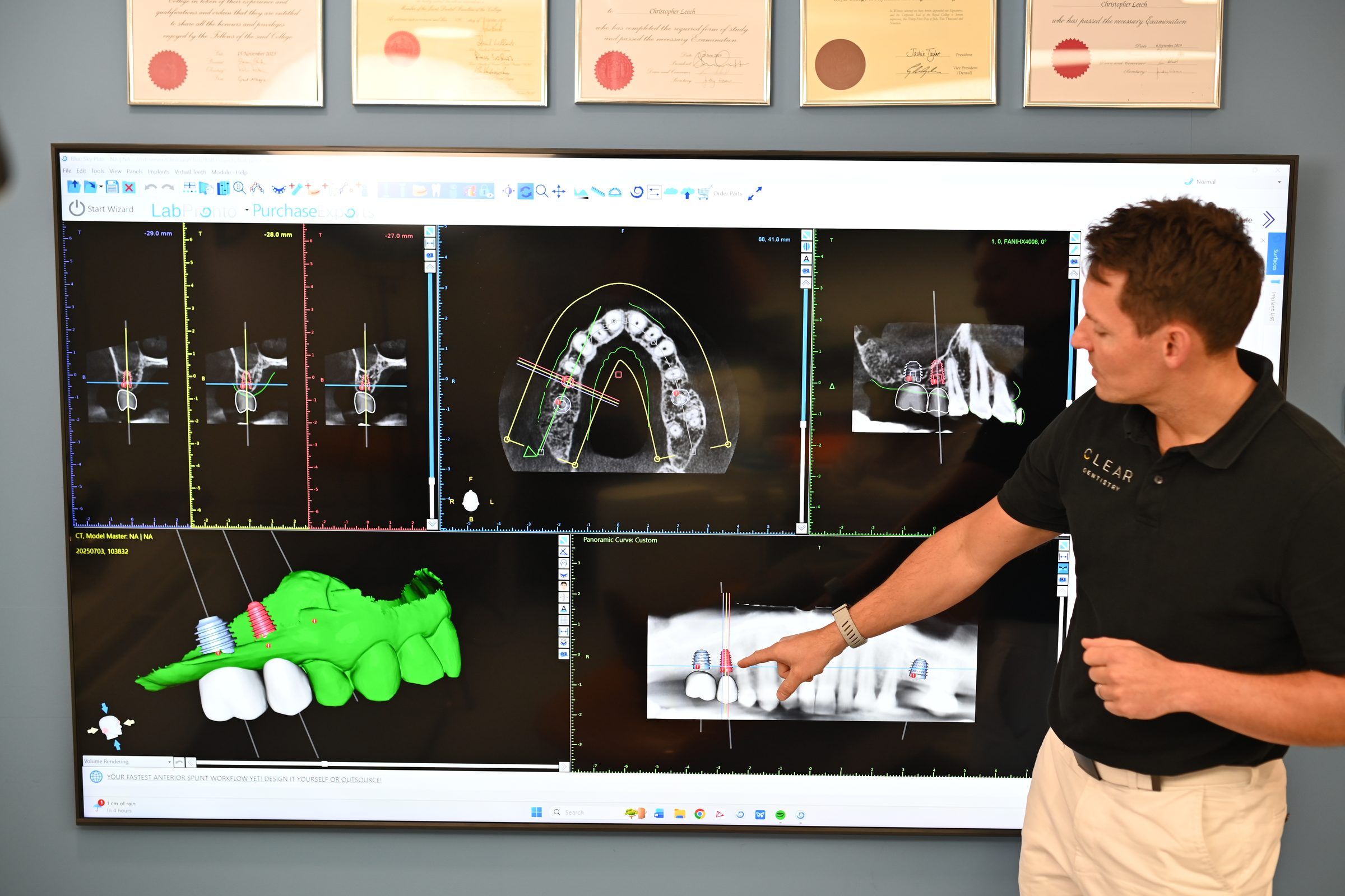 A 3D CBCT scan with planned implant positions