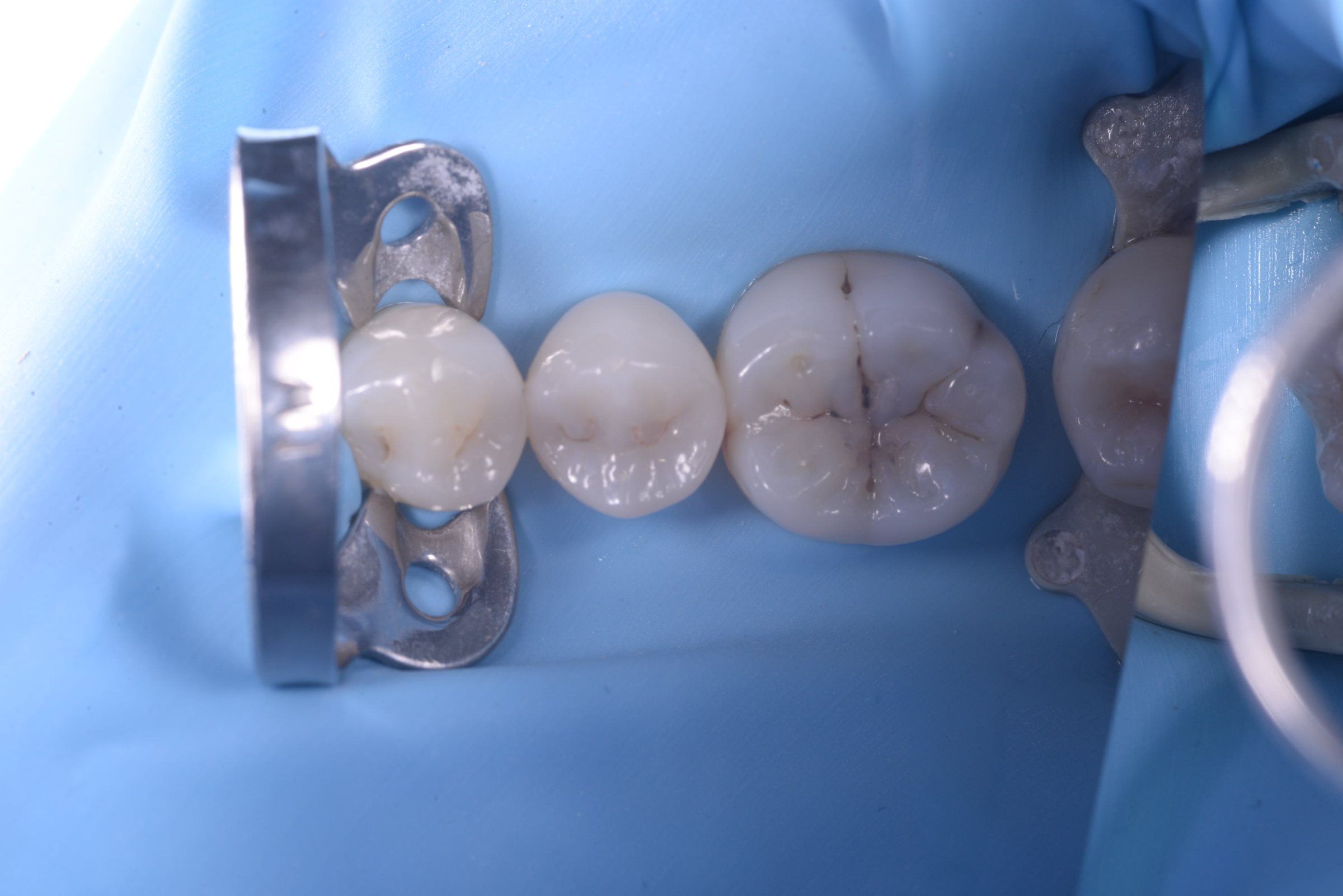 The same teeth isolated with a rubber dam before the filling is placed