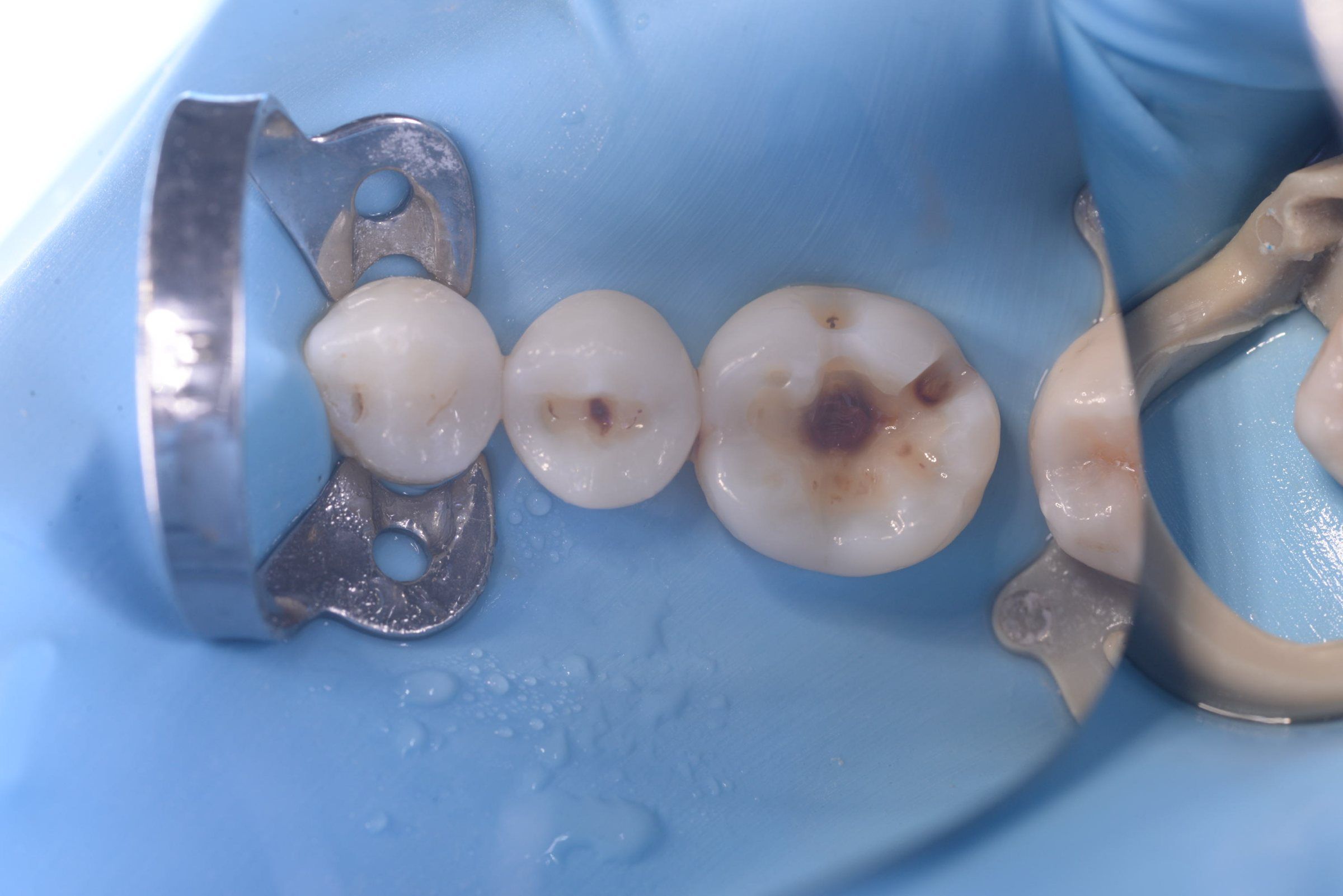The decay exposed inside the tooth, under rubber dam isolation