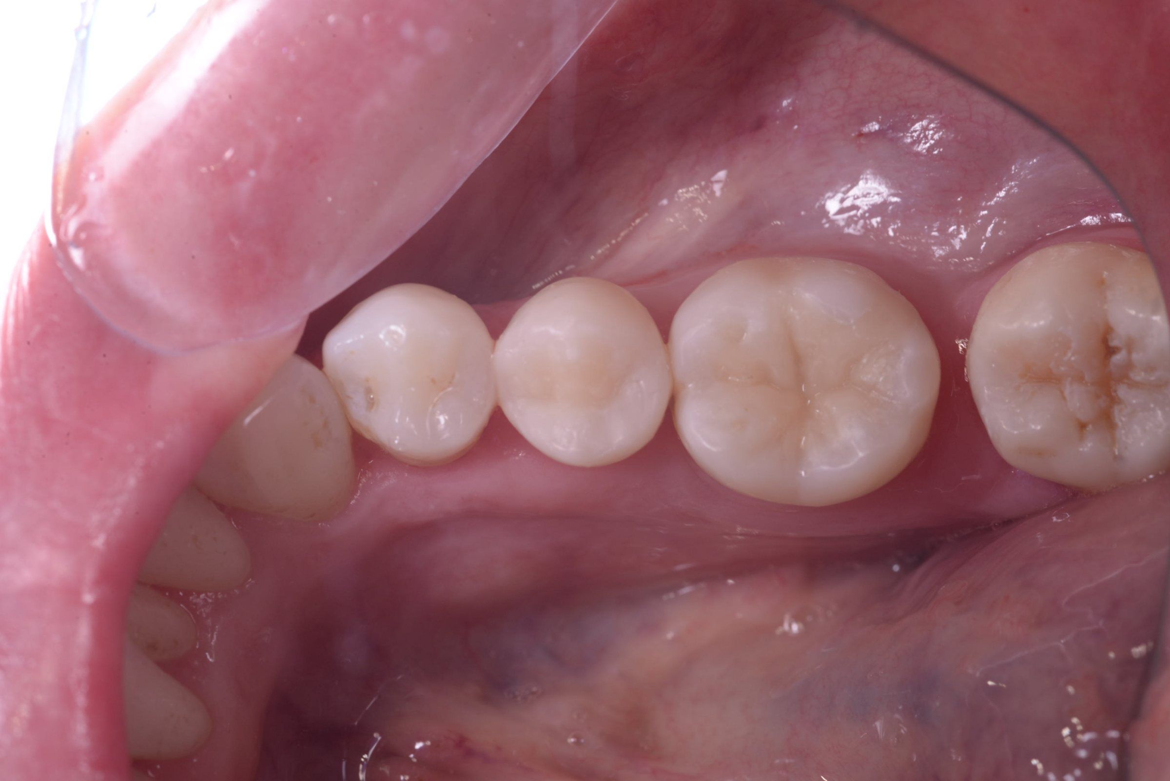 The finished tooth-coloured filling, shaped and polished to match the natural tooth